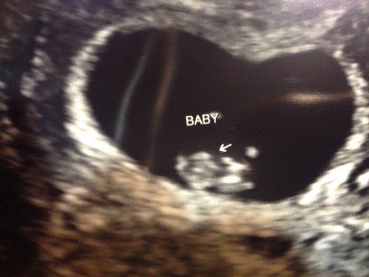  Kara's ultrasound 